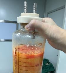霸州水动力吸脂手术要做多久？